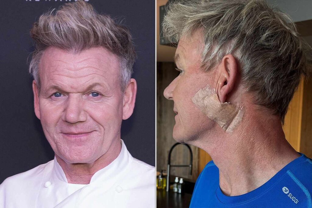 Gordon Ramsay Shares Skin Cancer Surgery Scar: ‘Don’t Forget Your Sunscreen’